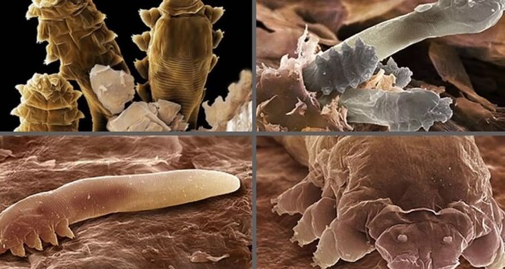 Arten menschlicher Hautparasiten